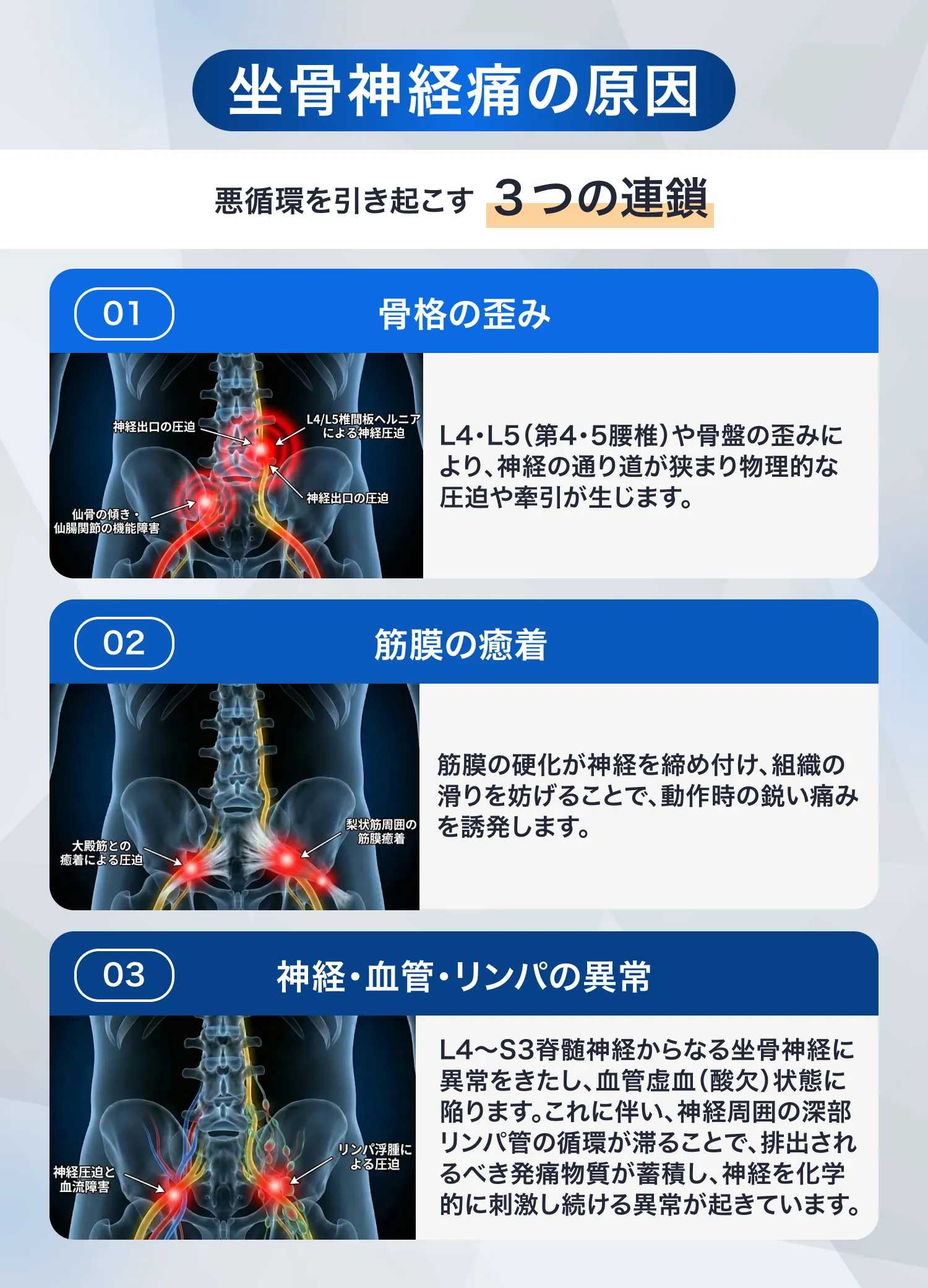 坐骨神経痛の3つの根本原因：骨格の歪み、筋膜の癒着、神経・血管・リンパの循環異常の解説図